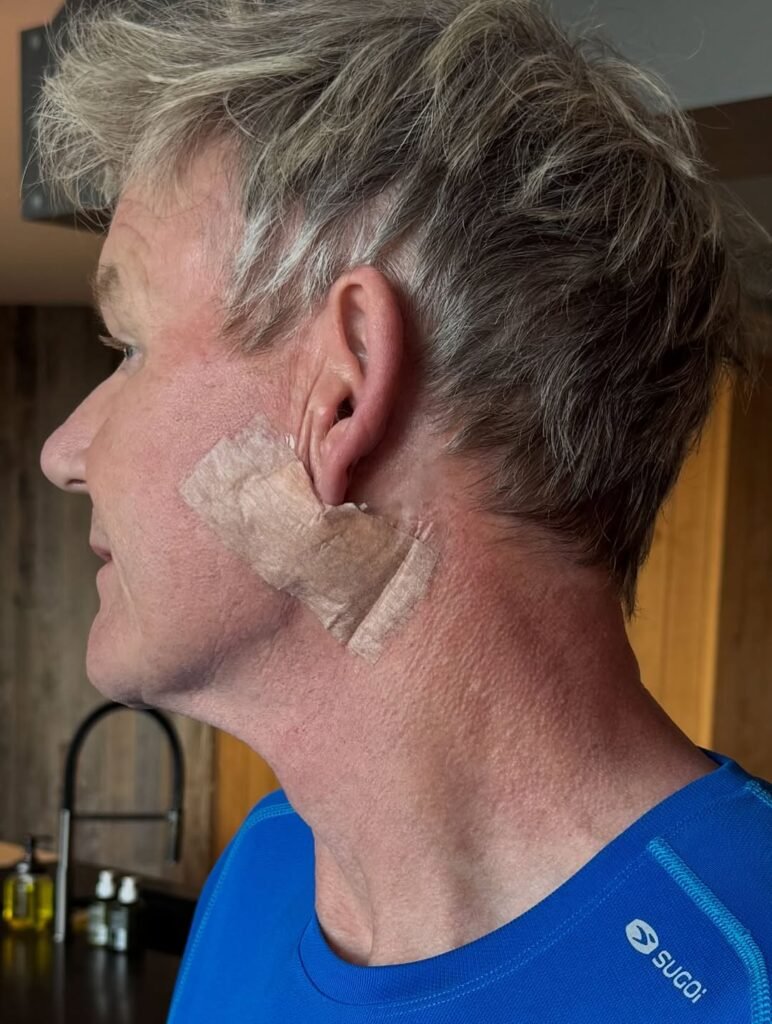 Gordon Ramsay Reveals Skin Cancer Treatment and Urges Sun Safety Awareness Gordon Ramsay Reveals Skin Cancer Treatment and Urges Sun Safety Awareness